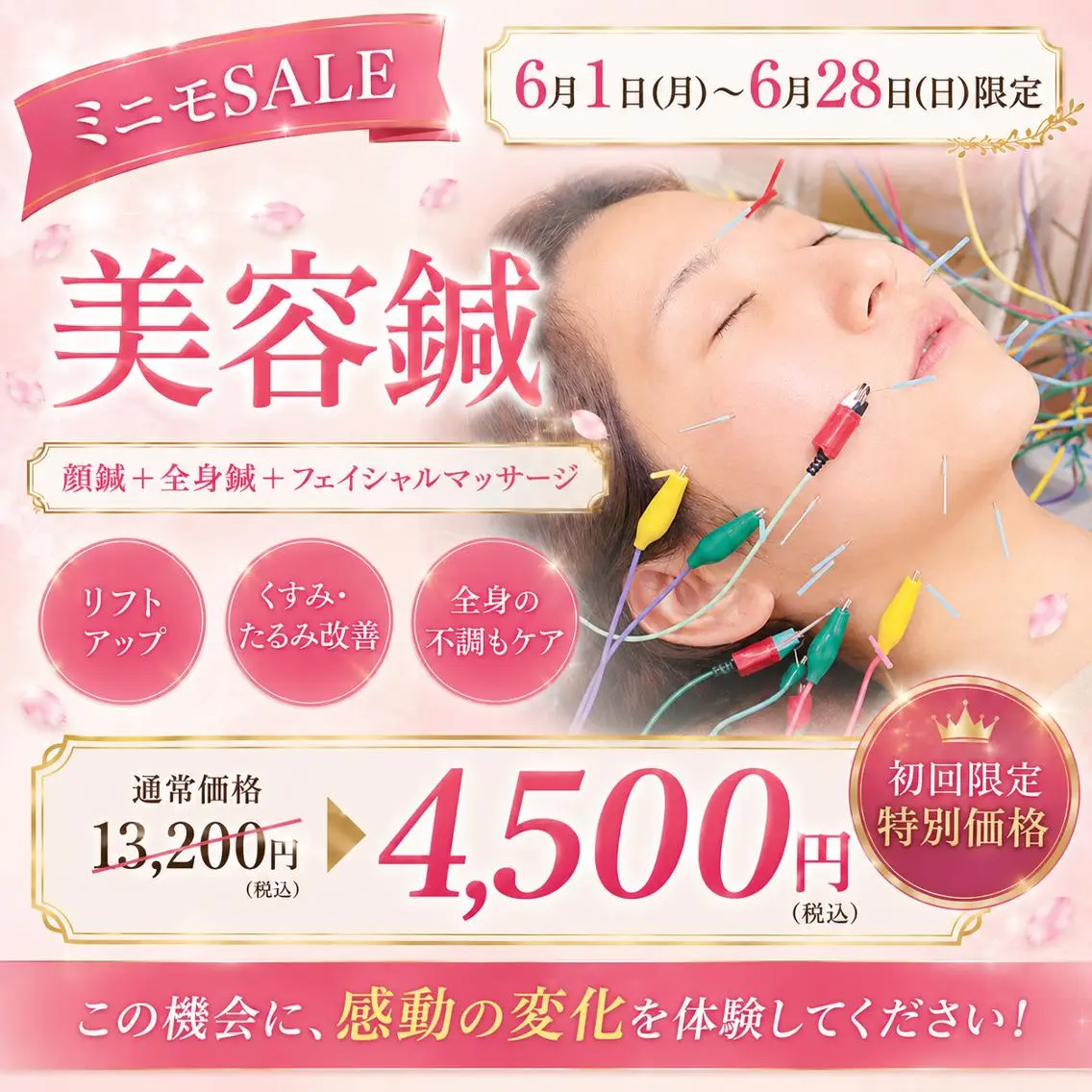 6/1〜6/28限定!人気No.2【美容鍼】90分⭐️顔針+身体針+フェイシャルマッサージの写真
