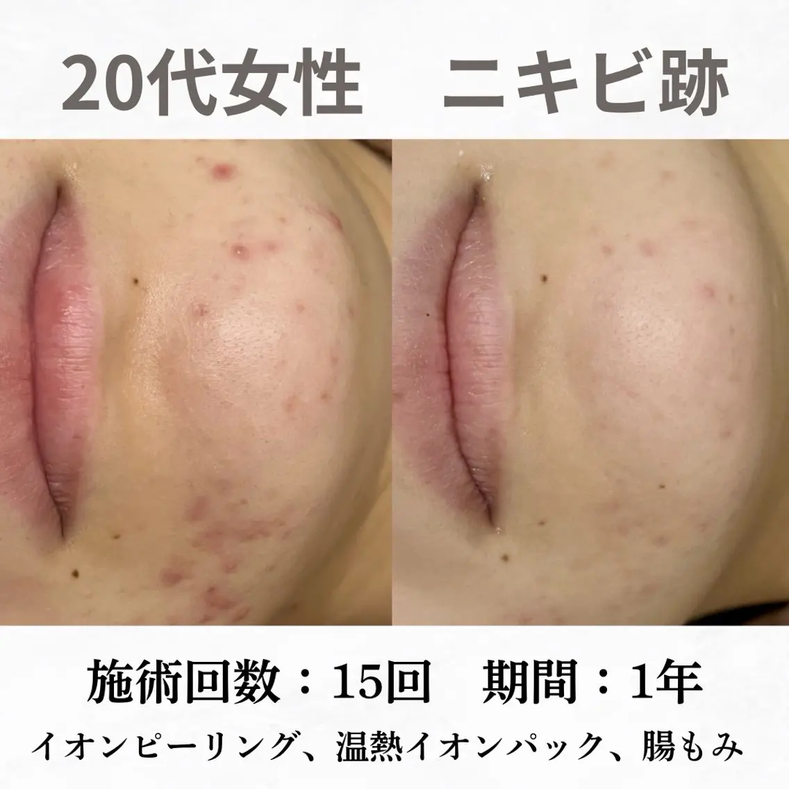 重度ニキビ専門🌼 ダウンタイムなしのエステ・リラクイメージ