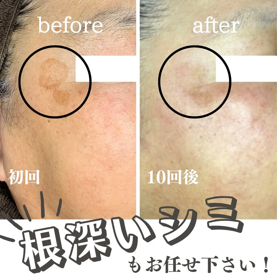 【最新の次世代シミケア】30ショットの写真