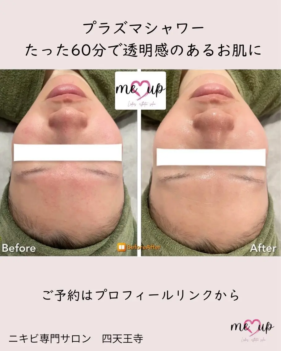 エステ Meupニキビ専門店 背中/ハーブ/肌管理のその他イメージ