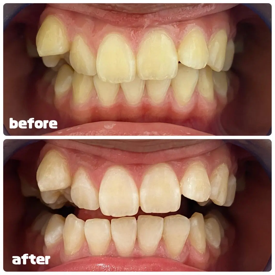 セルフホワイトニング 🦷口元垢抜け✨のその他イメージ