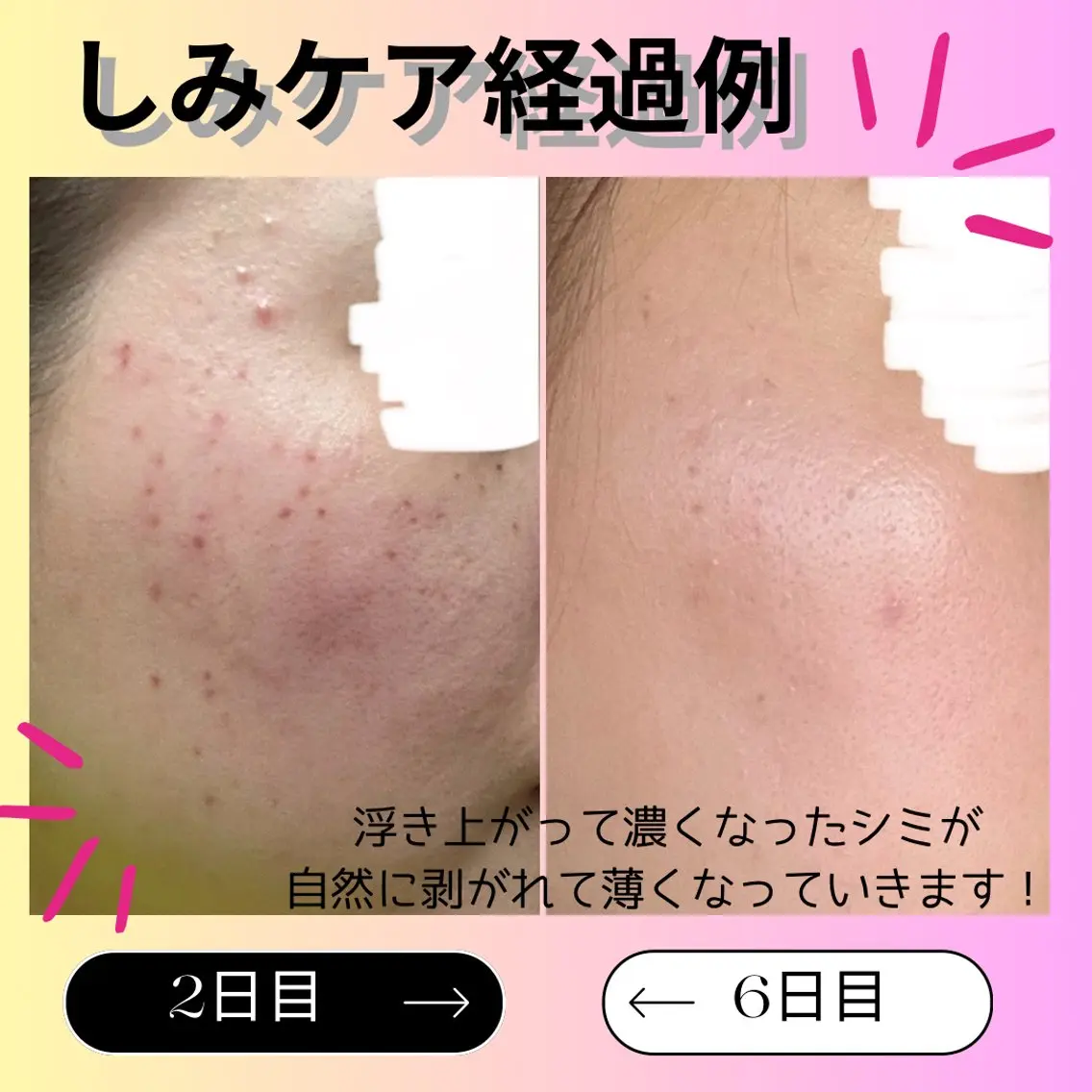 プラズマしみケア 30分 当て放題の写真