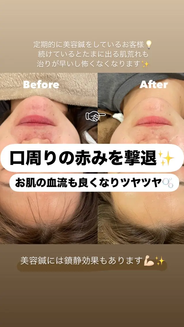 美容鍼/鍼灸 ここみ鍼灸院のエステ・リラクイメージ