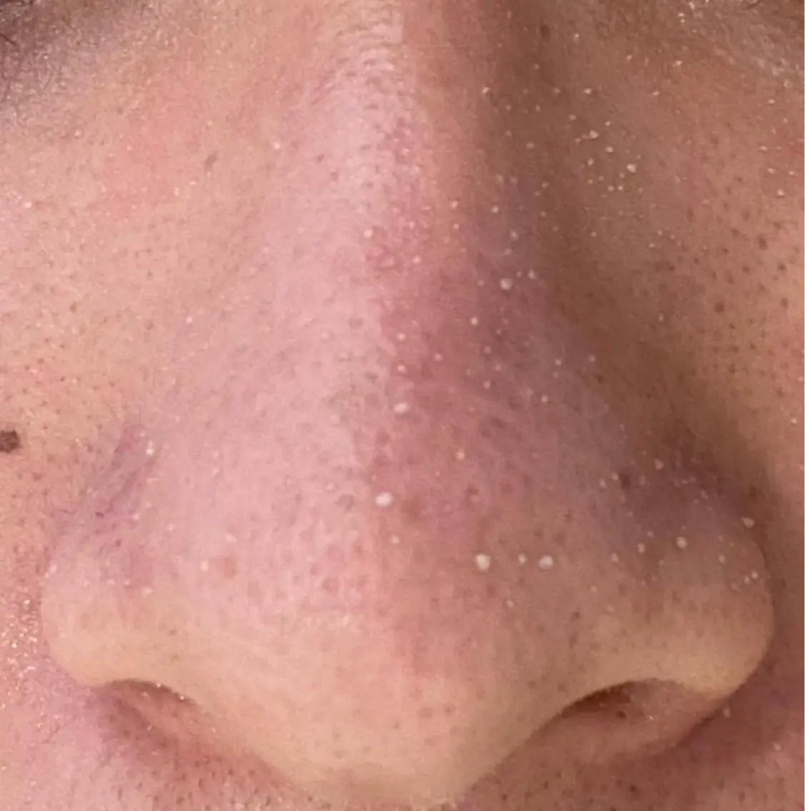 👃ブラックヘッド改善コース👃毛穴汚れ!酸化して黒くなっている毛穴へ自社開発の特別な美容液を使用して汚れを除去👀!の写真