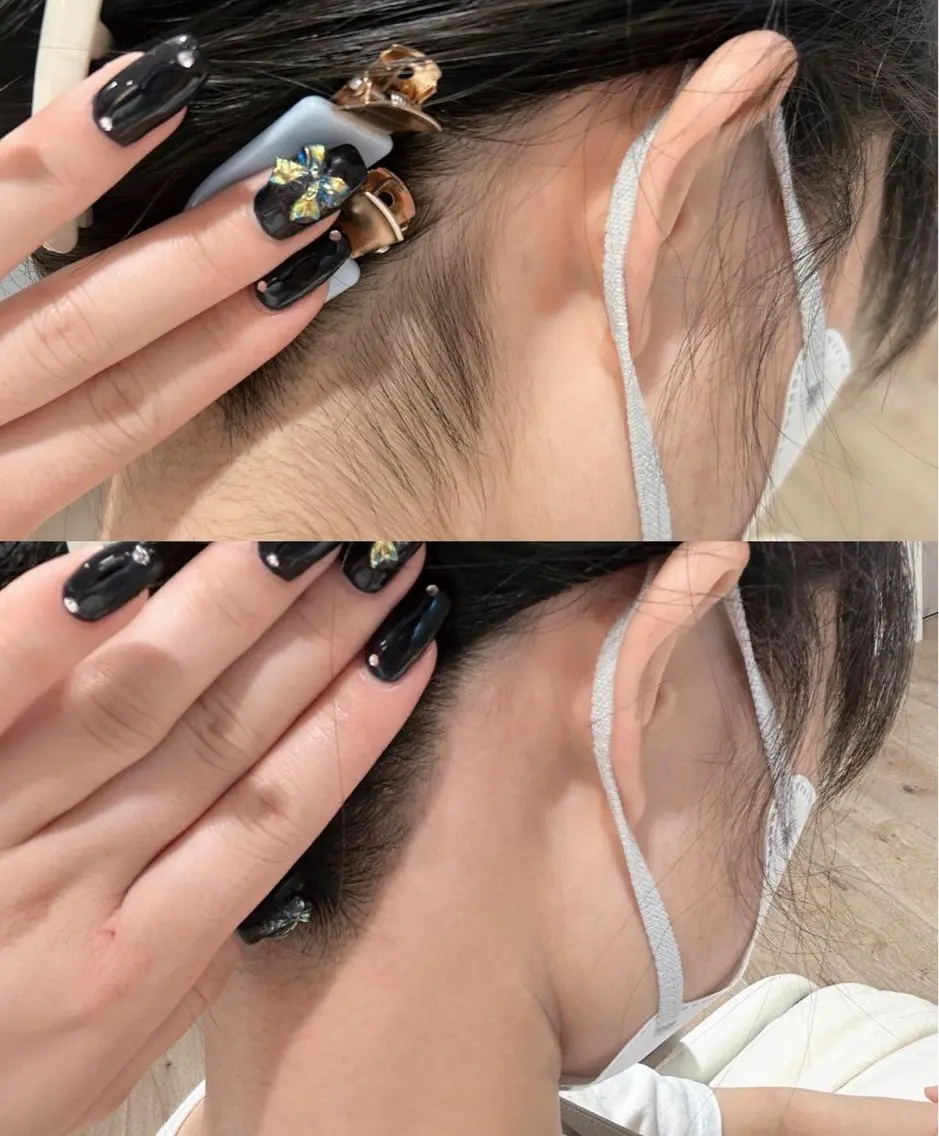 【全員】うなじワックス脱毛の写真