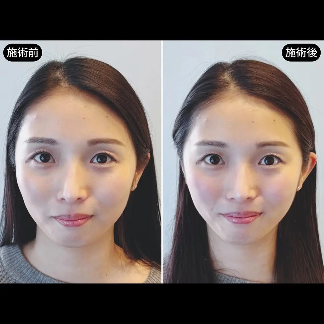 【左右差・食いしばりに】顔バランス調整×EMS美容鍼の写真