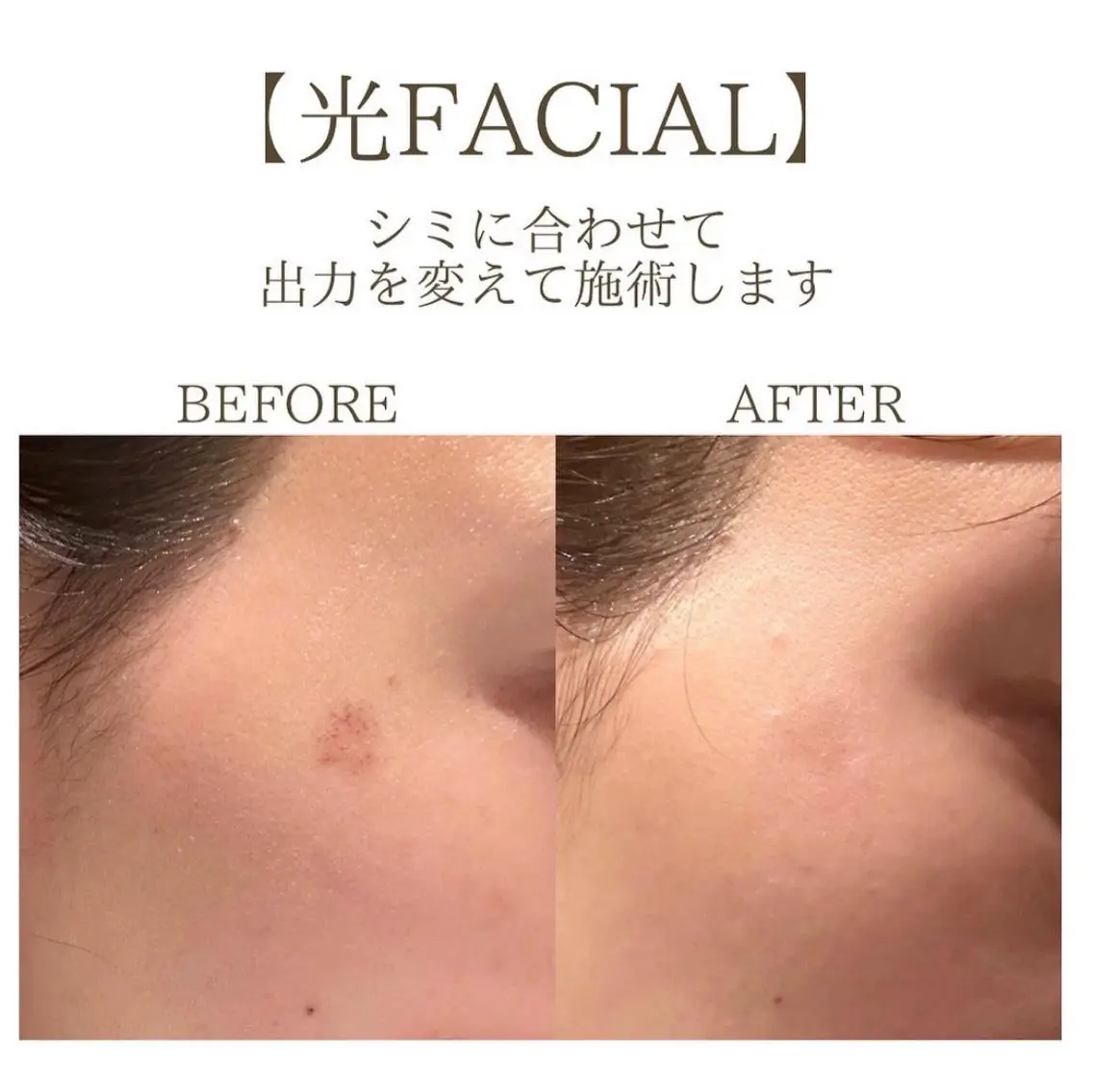 【本気の肌管理】光×RF×超音波×シミケア×氷結★シミ・たるみ・エイジングケア✨¥10,300の写真