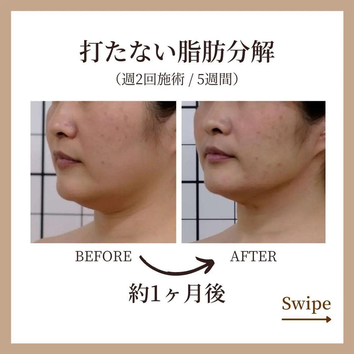 【超絶小顔!!】打たない最新メソセラピー 約30分の写真