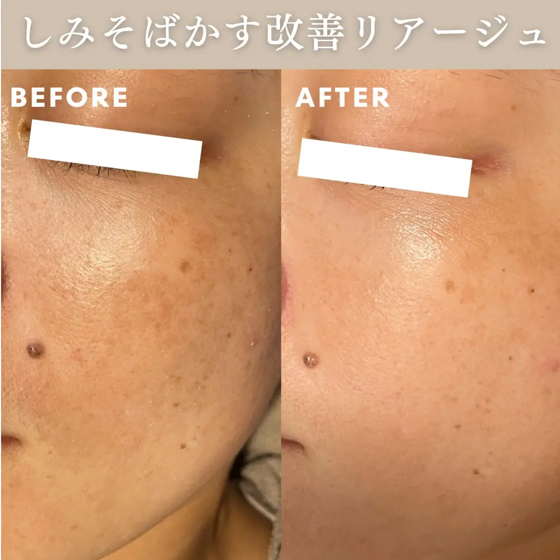 【シミ改善🪄】レーザー卒業したい方へ!美容液パック付き/肝斑、色素沈着等OK!の写真