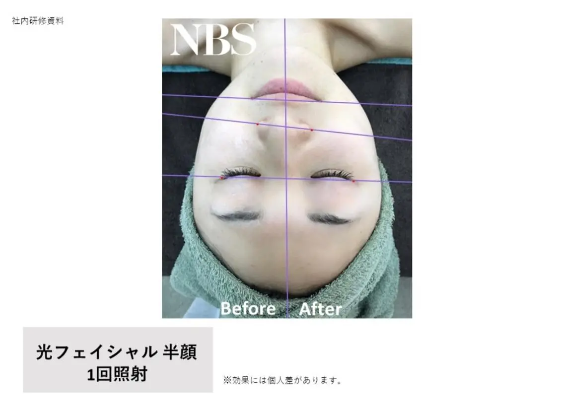 《口コミ限定》【光フェイシャル＋パック付】💆‍♀️ 小顔•美白•透明感を手に入れたい方✨気になるお肌悩みに！の写真