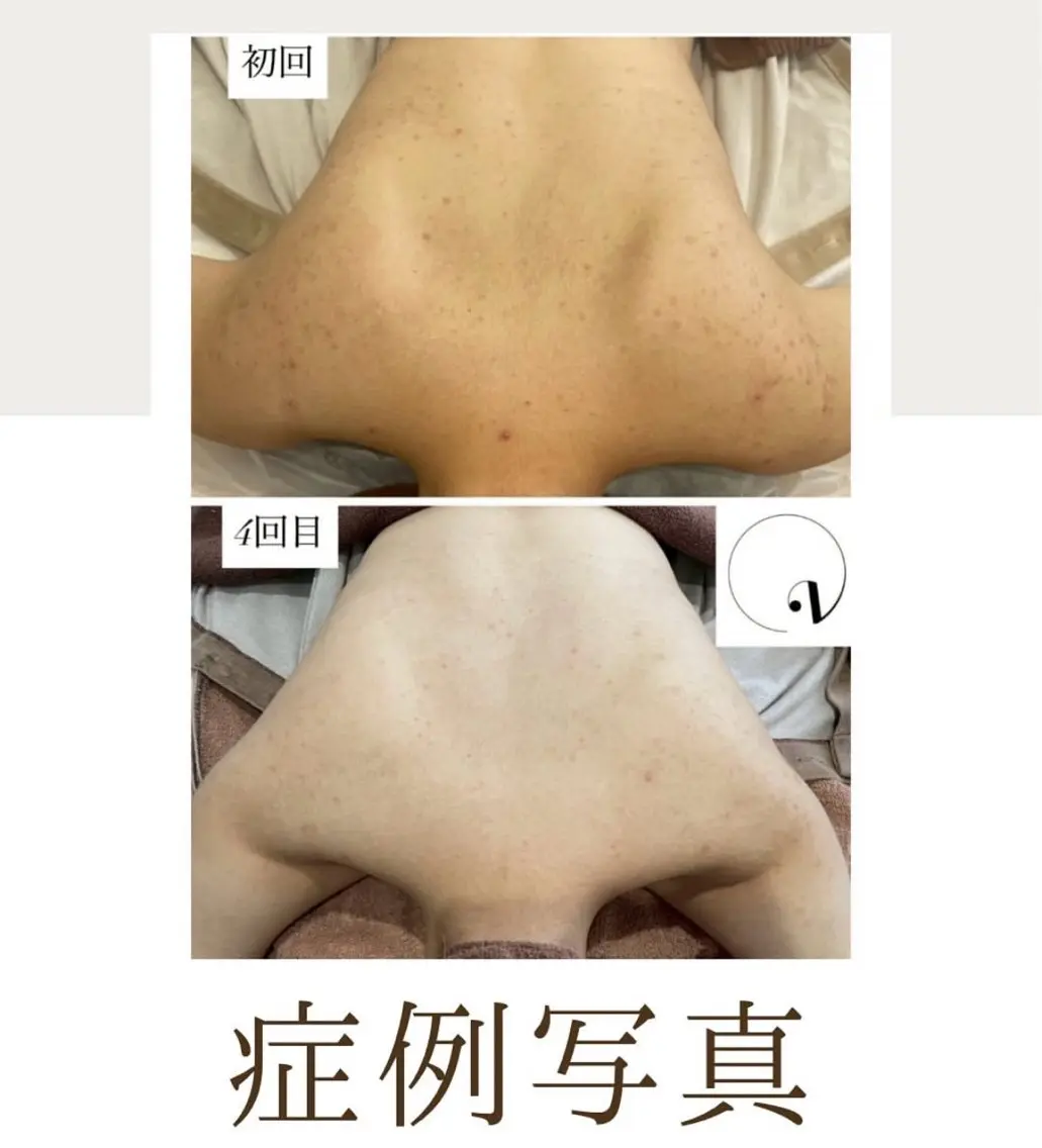 背中ハーブピーリング(背中上部のみ)🌿気になる背中ニキビ・背中の色素沈着💦ウェディング👰♀️等に人気⭕️の写真