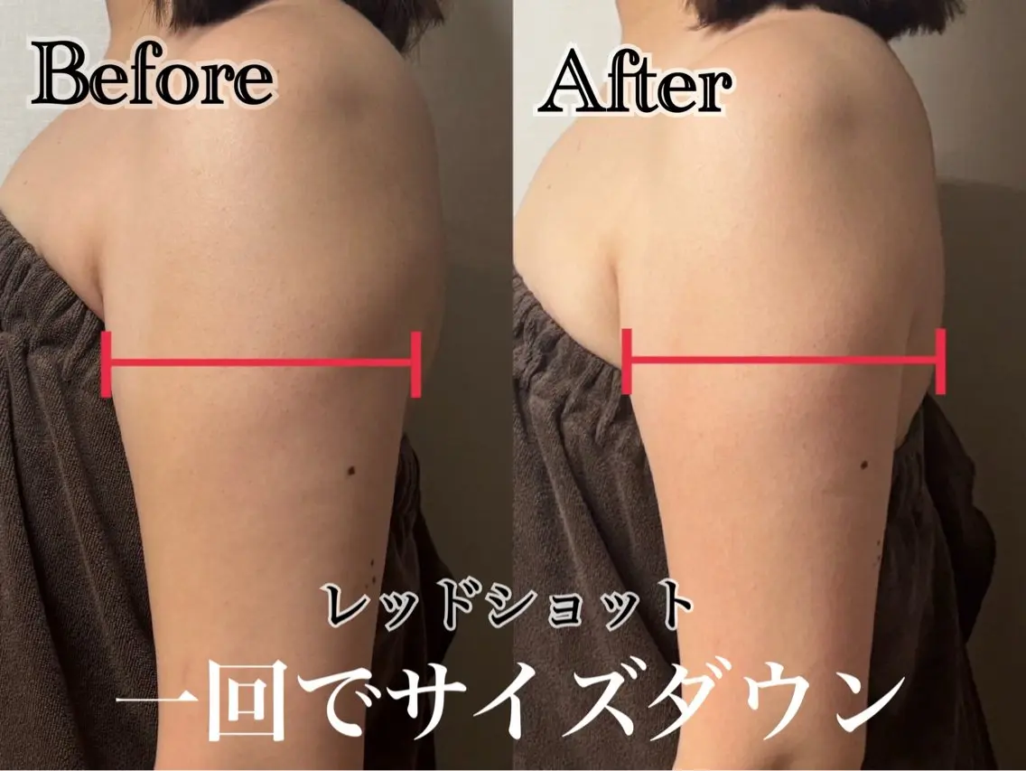【レッドショット導入価格✨】韓国発🇰🇷最新美容脂肪撃退💉🩸二の腕またはお腹3cc導入❤️‍🔥EMSラジオ波付きの写真