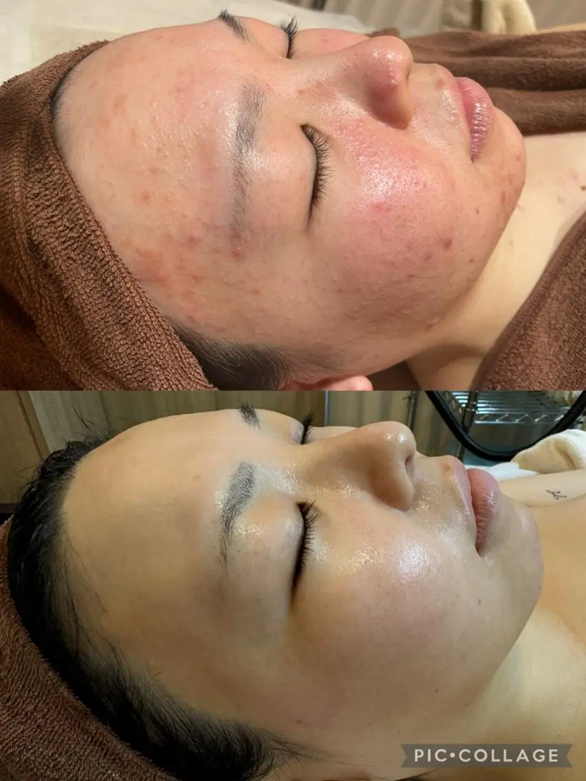 🫧今後の肌老化対策🫧毛穴＆高保湿＆リフトアップフェイシャル75分💧ごっそり毛穴洗浄＆デコルテ、顔マッサージ付！の写真