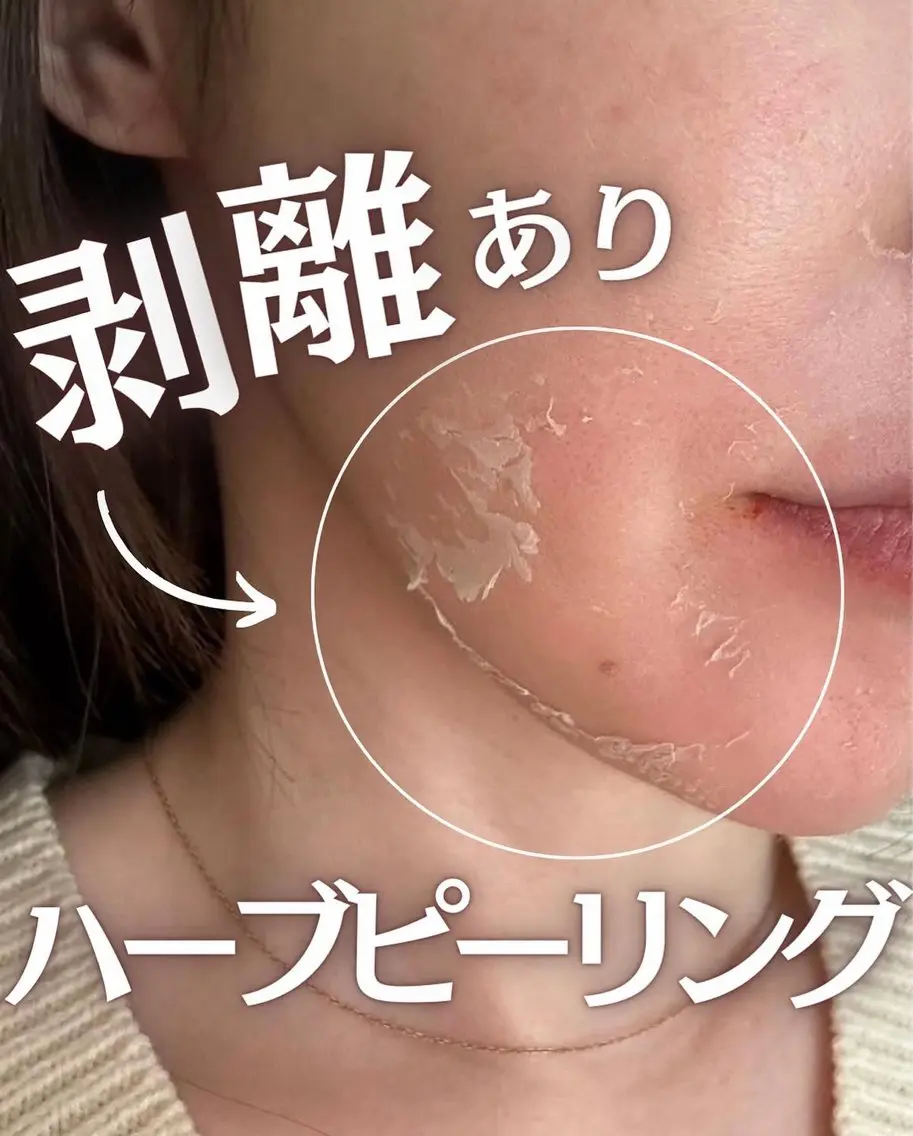 【剥離ありハーブピーリング】💎古い角質をケアして透明感UP🫧の写真