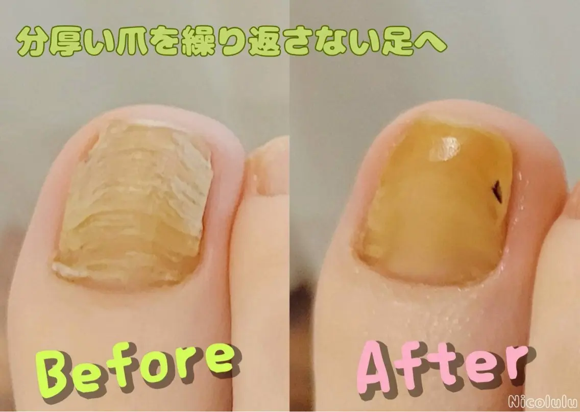 期間限定モニター【分厚い爪！伸びない爪！諦めない！】5月まで12800→8000の写真