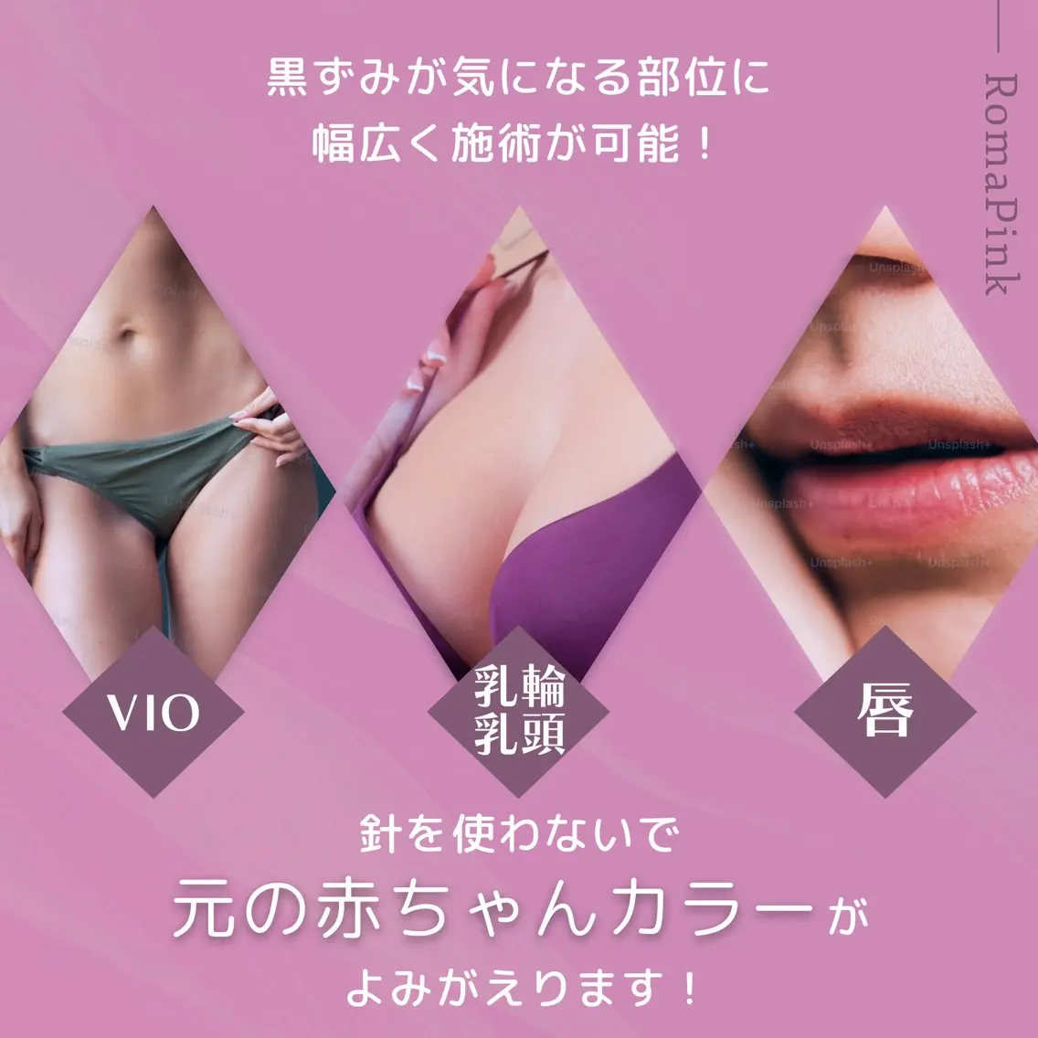 ローマピンク【脇orヒップ下】 モニター特別価格40%OFFの写真