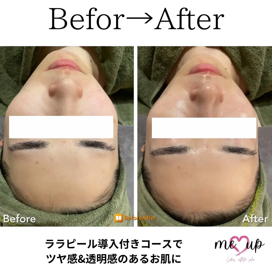 エステ Meupニキビ専門店 背中/ハーブ/肌管理のその他イメージ
