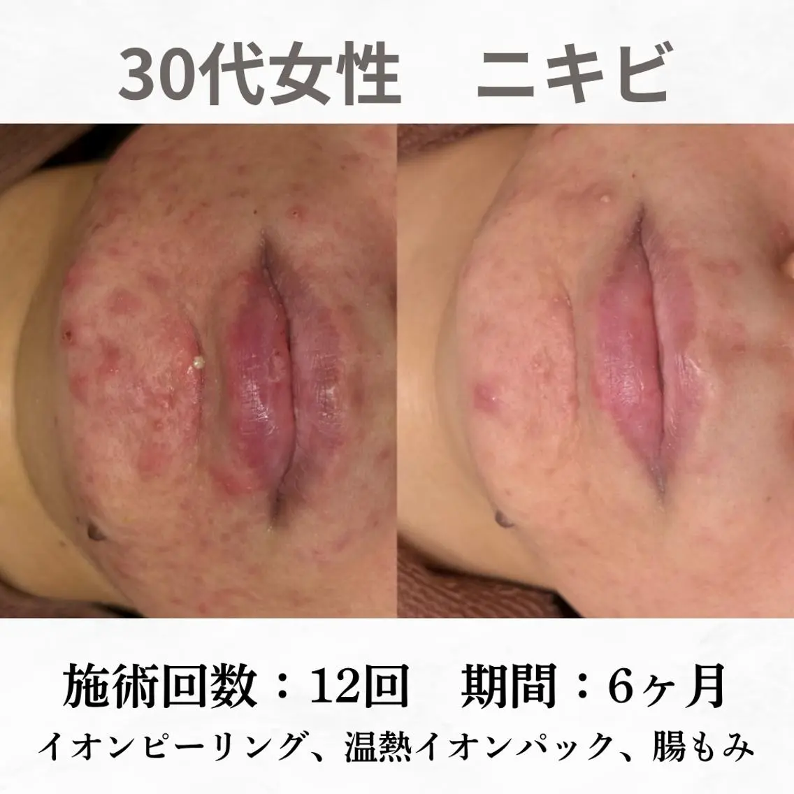 重度ニキビ専門🌷 ダウンタイムなしのエステ・リラクイメージ