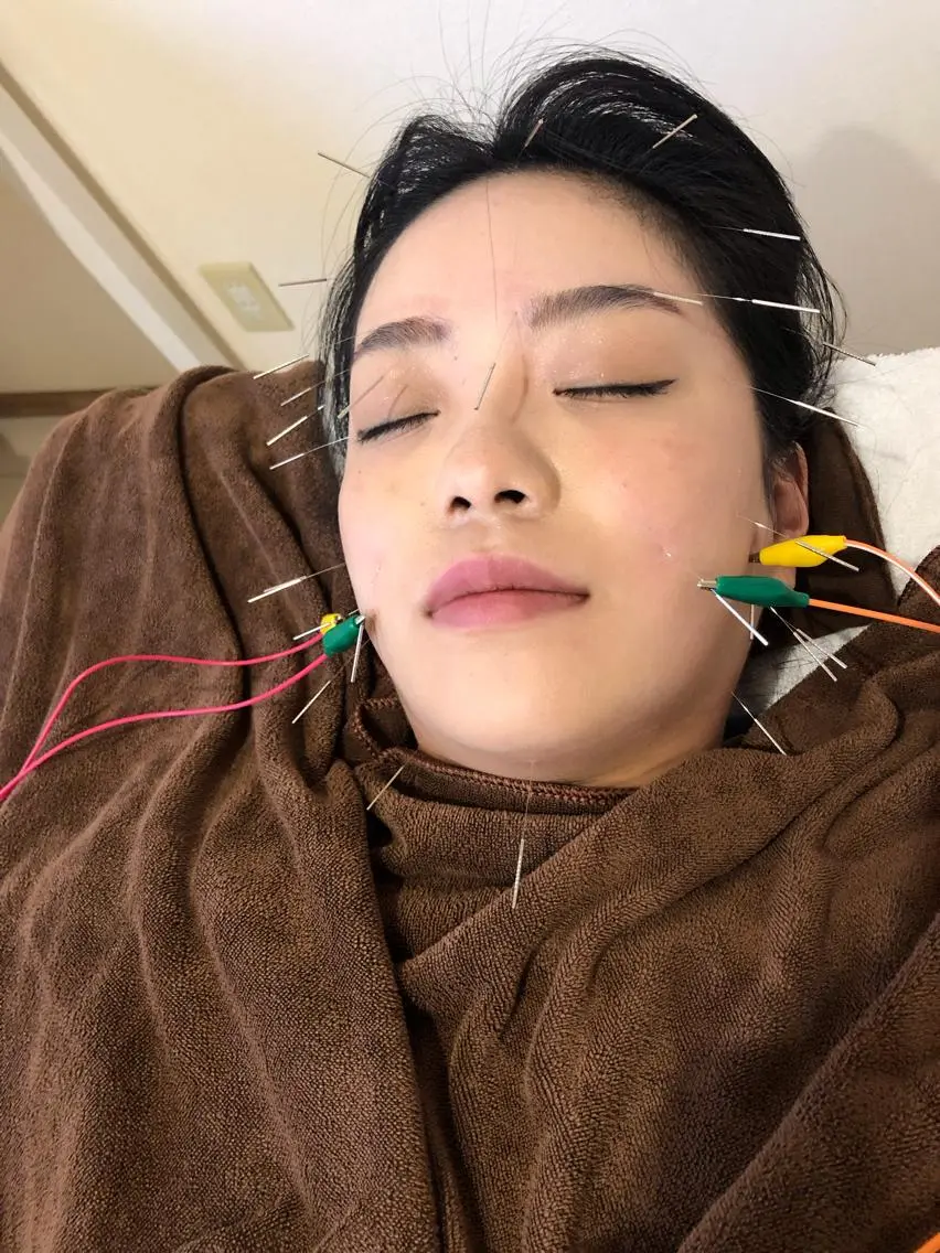 癒し効果✨NO4 ㊙️美顔電気鍼+腸マッサージ👍の写真