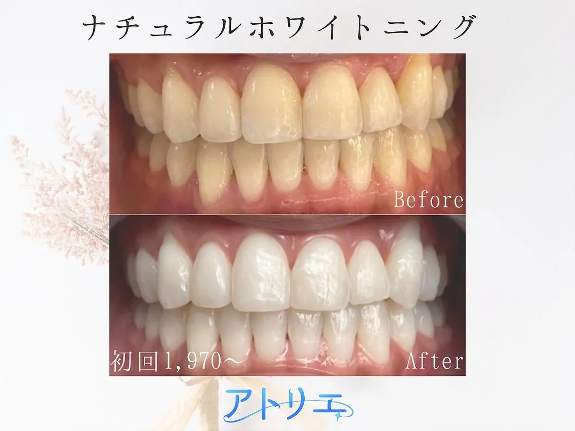 【ミニモ限定2,970円】23時迄営業★1席限定の完全個室で照射20分!!圧倒的白さ実感!の写真