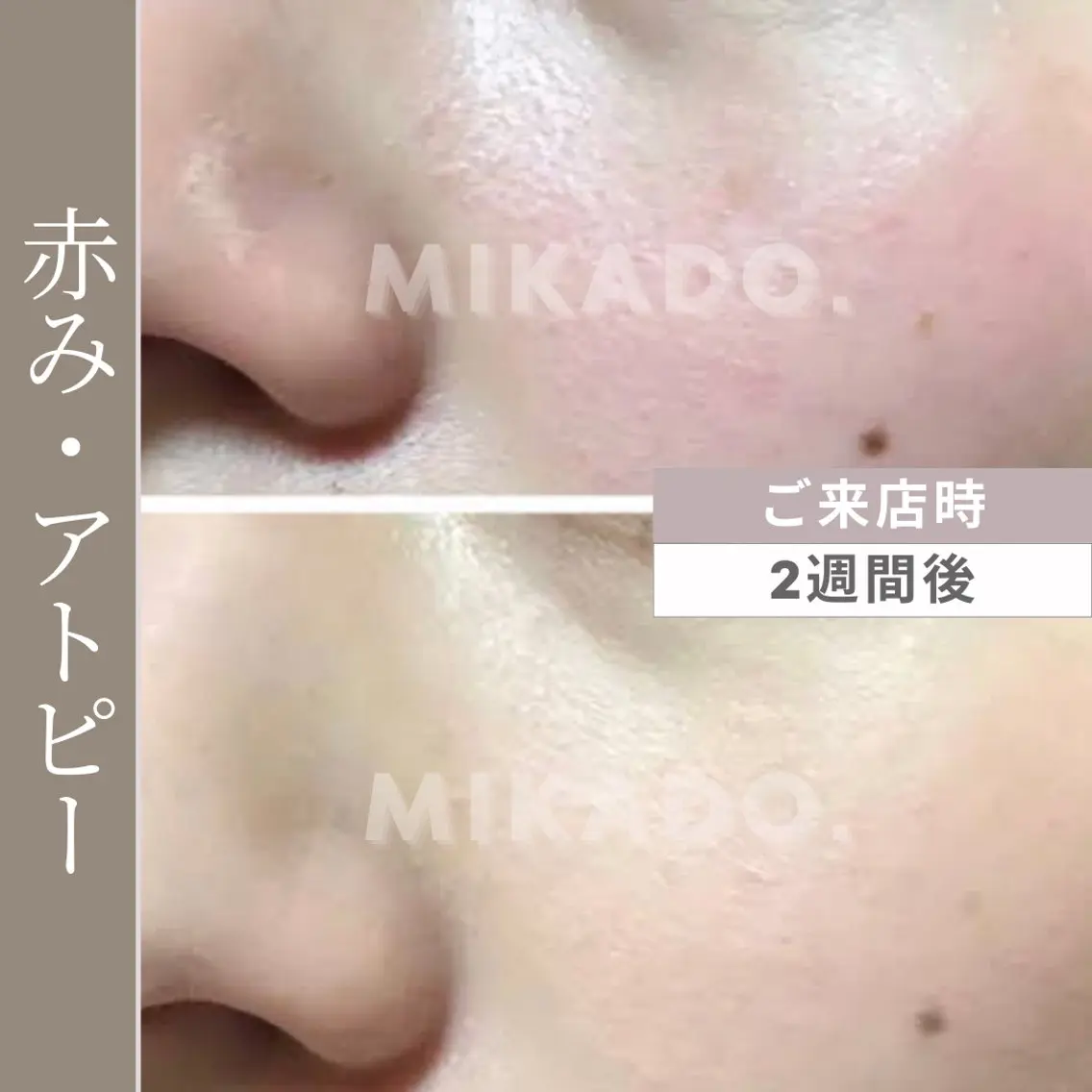 【赤み、アトピーに】本気で肌質改善!天然ハーブピーリング グリーンピールソフト1Days ¥13240の写真