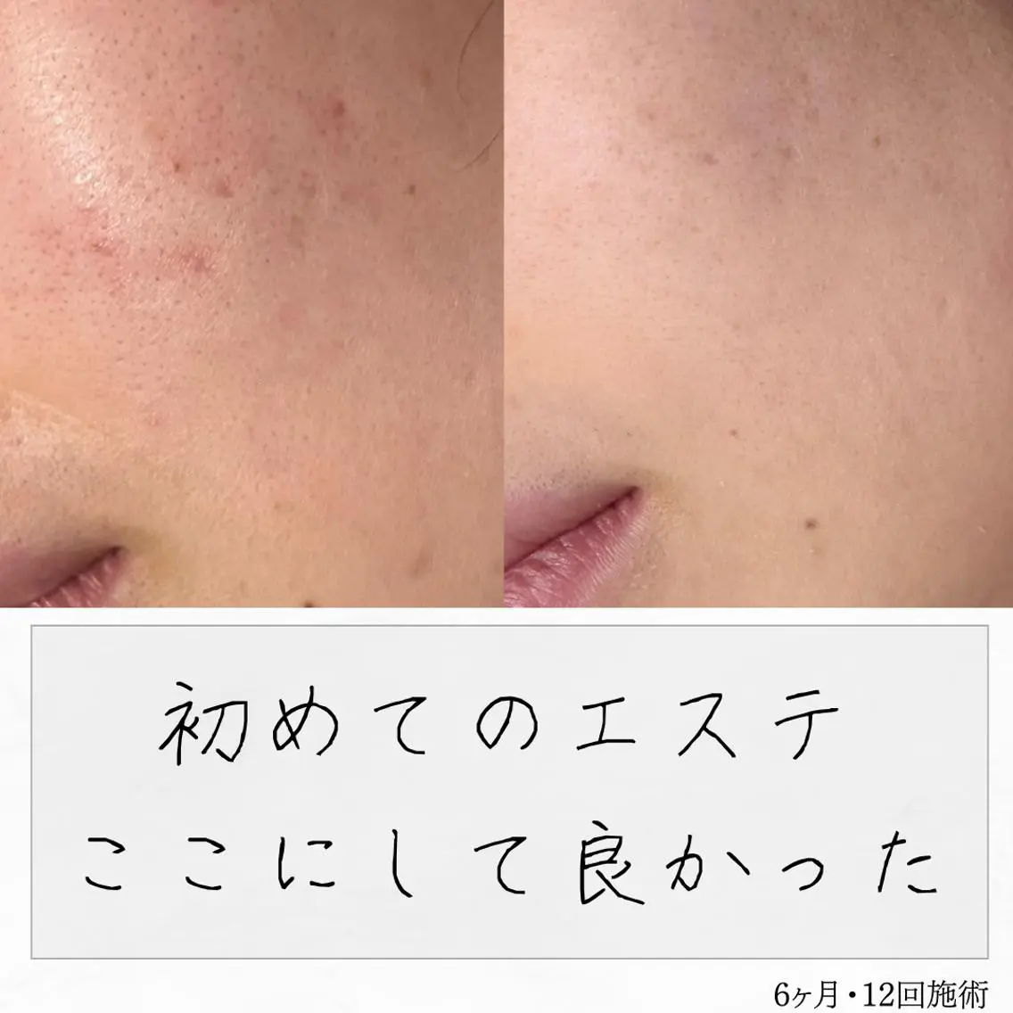 ニキビ経験者が施術 する専門サロン🌻のエステ・リラクイメージ
