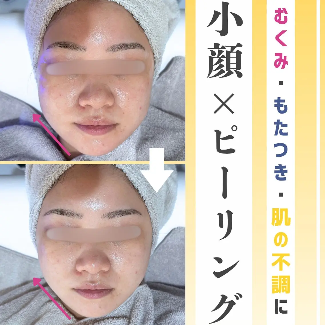 〈NEW🐰〉お好きなピーリング➕小顔施術➕ドライヘッドスパ🫧の写真