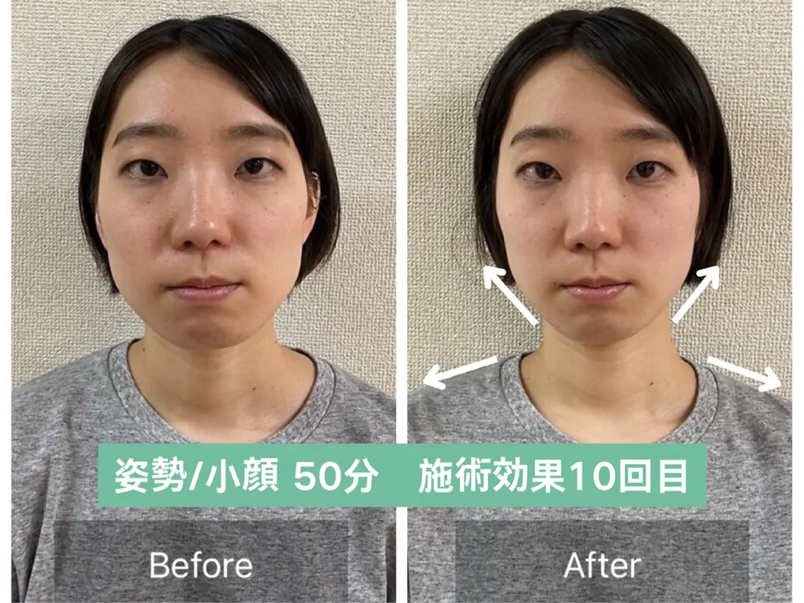 【3.40代必見!】法令線の深さ/骨格リフトアップ小顔矯正【50分17900→3400】の写真