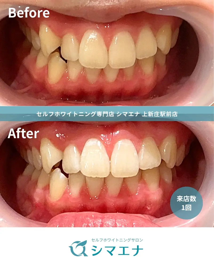 その他 セルフホワイトニング シマエナのその他イメージ