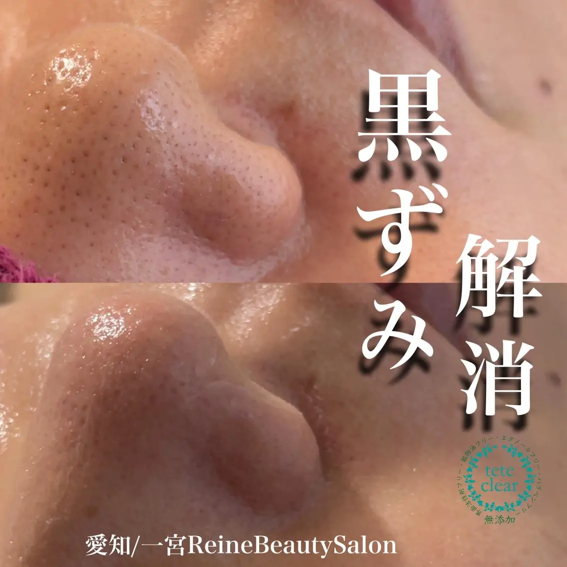 毛穴/シミ肝斑/脱毛 横山梨里のエステ・リラクイメージ