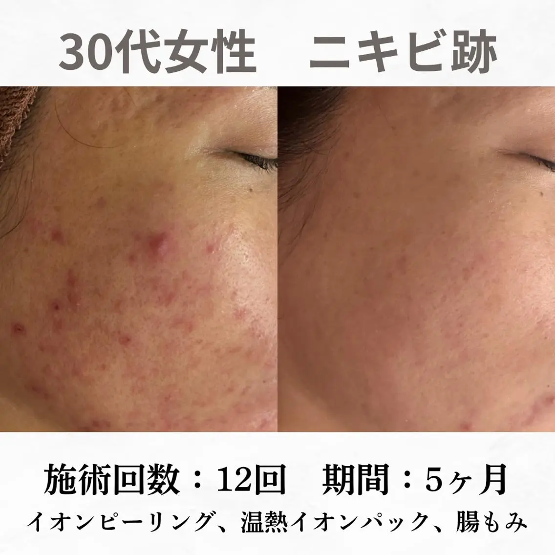 重度ニキビ専門🌷 ダウンタイムなしのエステ・リラクイメージ
