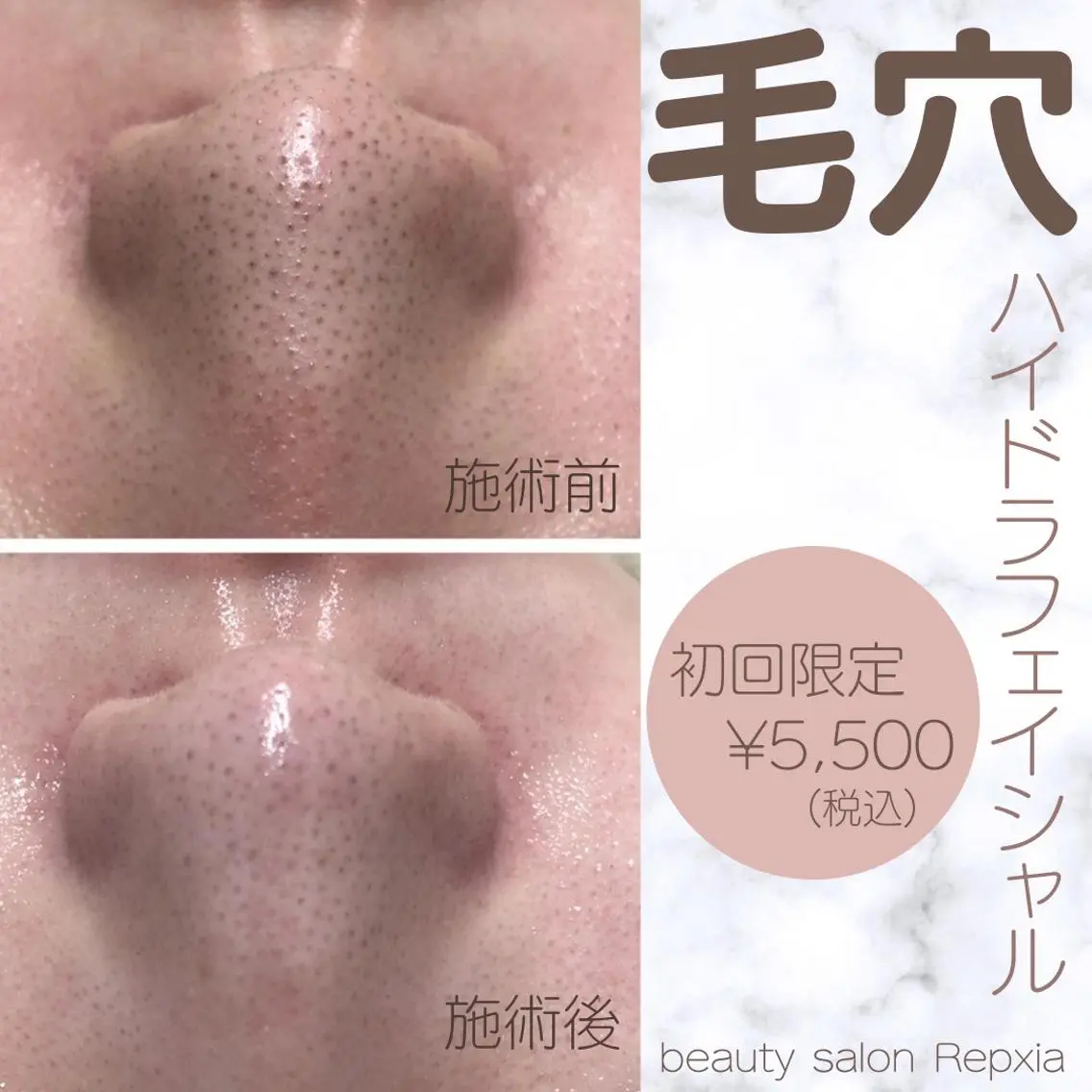 【ハイドラフェイシャル♪】新鮮な水素を発生させ洗浄と吸引で頑固な皮脂や角栓を一掃!ニキビのお悩みにも最適♪の写真