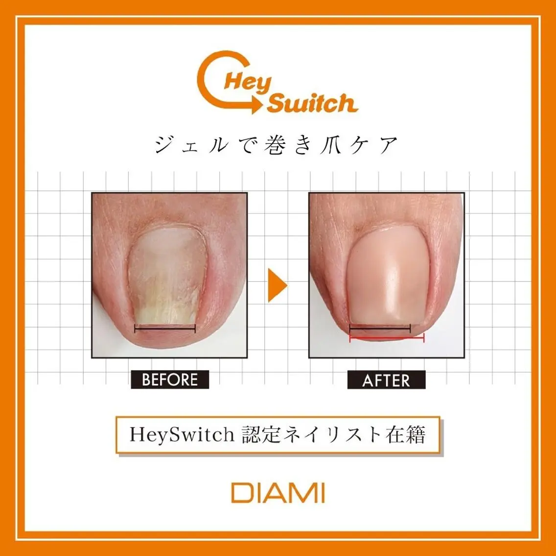 巻き爪ケア✨の写真