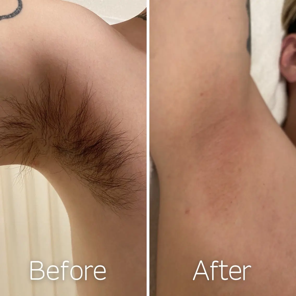 全身脱毛コース(顔 VIO込)の写真