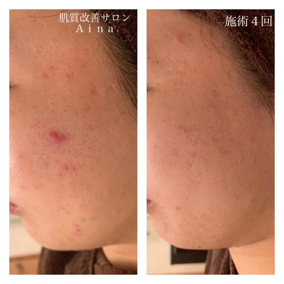 ロング カラー パーマ ヘアアレンジ メンズ キッズ ネイル マツエク・マツパ ニキビ跡専門サロン Ainaのエステ・リラクイメージ