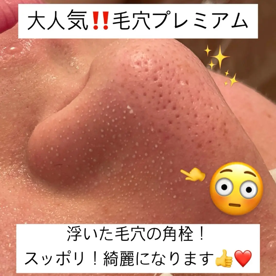 【全顔毛穴ケア🧼】✨当店人気No.1✨オプション込みのメニューです☺️スクライバー付き🧹の写真
