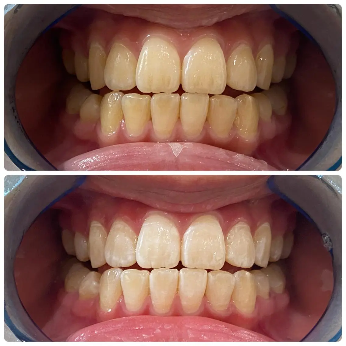 その他 セルフホワイトニング 🦷口元垢抜け✨のその他イメージ