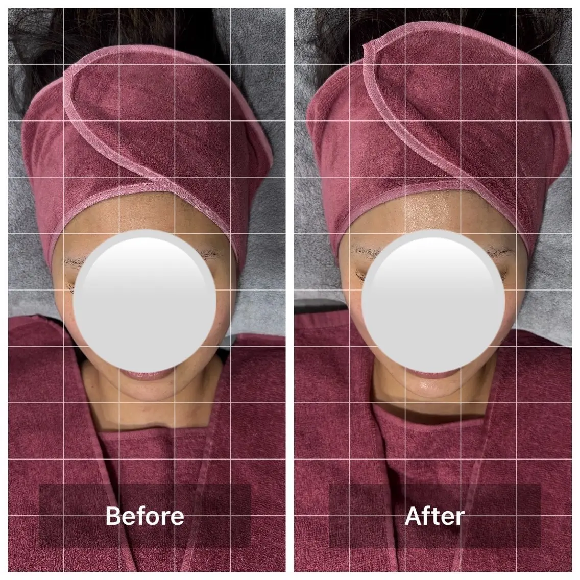リフトアップコース+毛穴収縮コースの写真