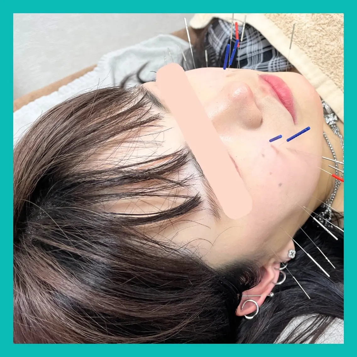 🌸エイジングケア電気美容鍼(40本刺した鍼の全てに電気を流します)🌸即小顔効果あり🪡の写真