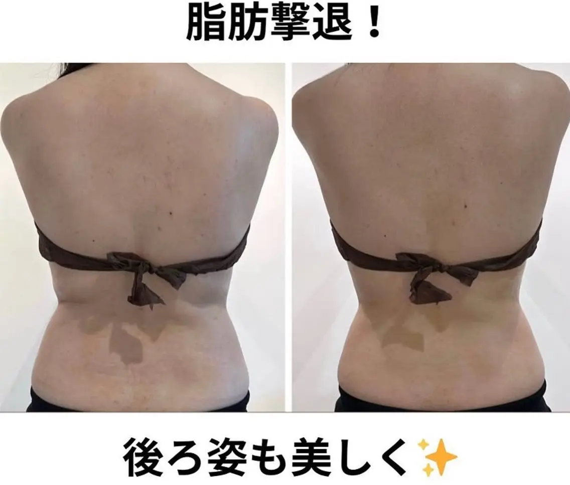 ❤️痩身+小顔❤️背面キャビorハイパー痩身+痩身アロマ60分+小顔コルギ+デコルテ首肩40 💚計100分¥7380の写真