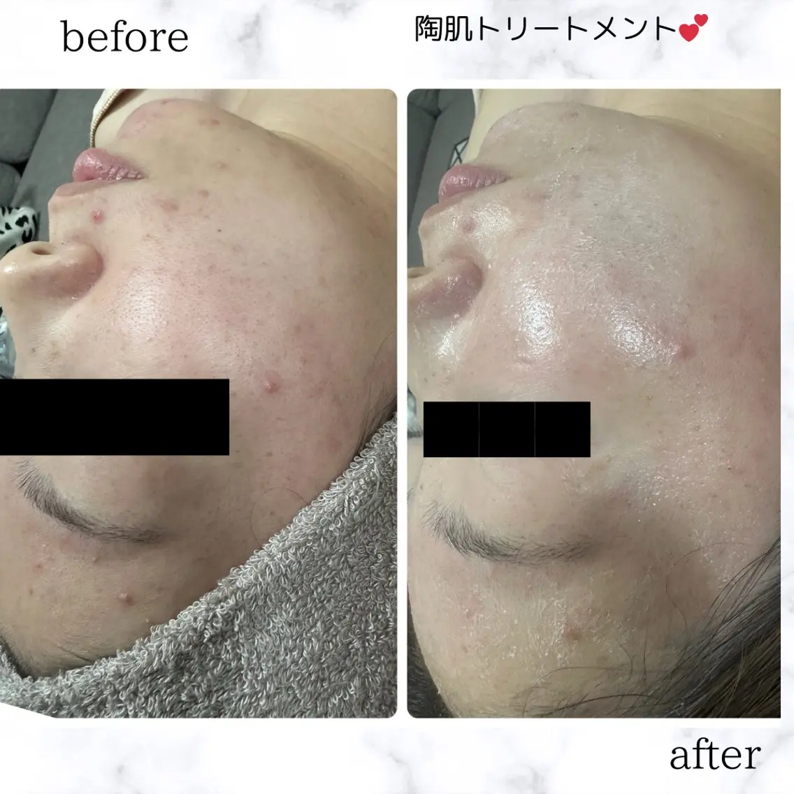 ニキビ撃退コースの写真