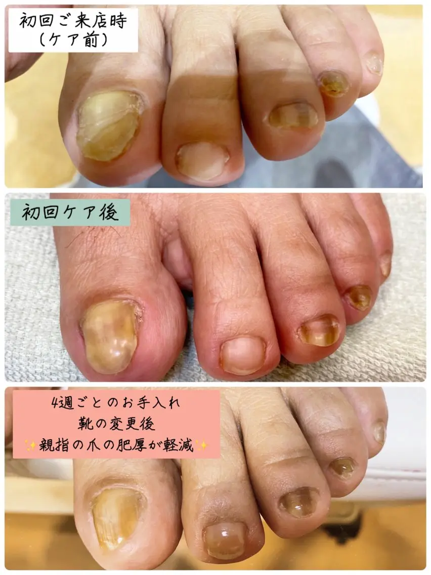 【モニター特別クーポン】◆爪トラブル(中〜重度)◆陥入/肥厚/巻き爪【トラブルケア】の写真
