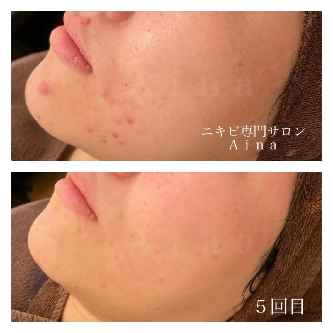 ミディアム カラー パーマ ヘアアレンジ メンズ キッズ ネイル マツエク・マツパ ニキビ跡専門サロン Ainaのエステ・リラクイメージ