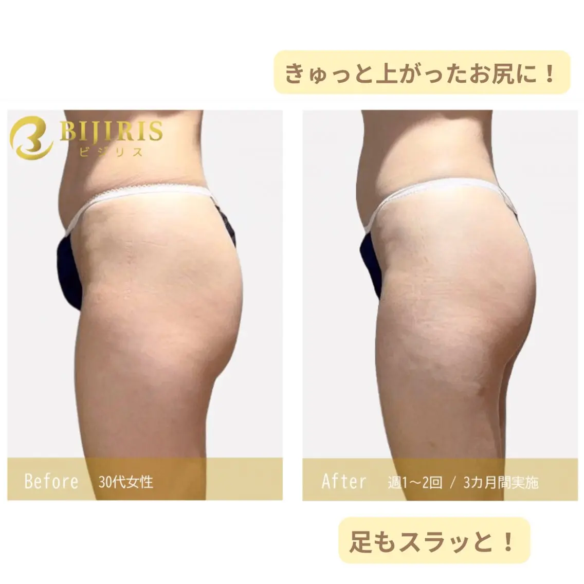 セルフ脱毛/美尻イス キングスサロン熊本のエステ・リラクイメージ
