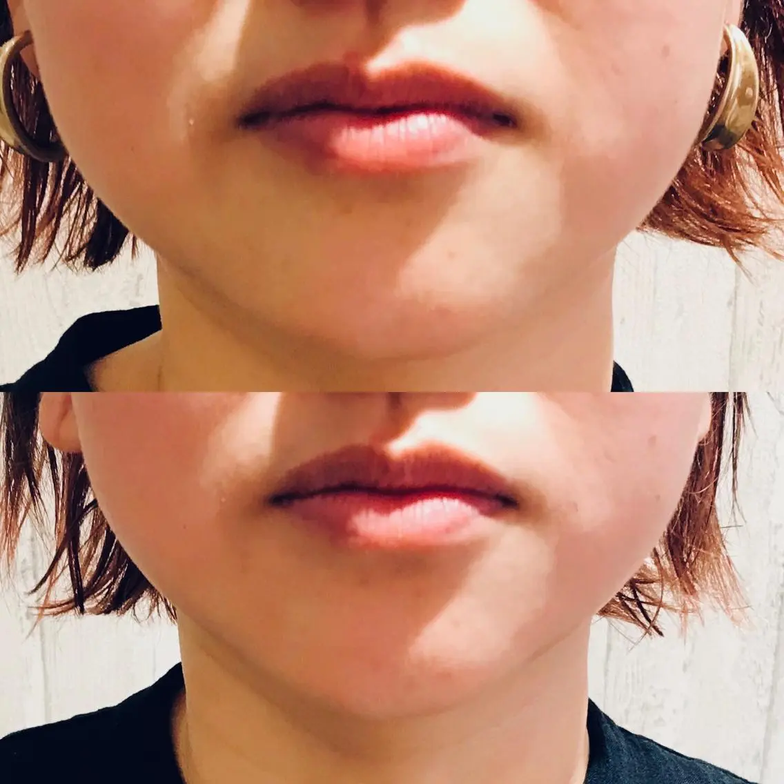 【期間限定ご褒美メニュー】目指せ小顔‼️フェイシャルエステ初回施術の方（お顔引き締め・リフトアップ&トラネキサム酸導入）の写真