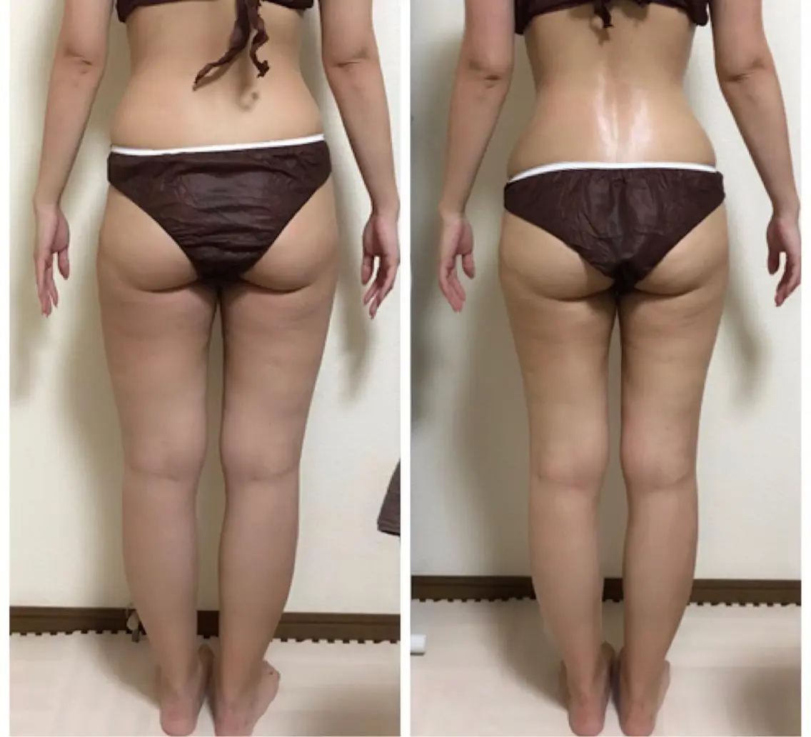 【人気No.1鬼痩せコース】よもぎ蒸し+スリムレーザー30分の写真