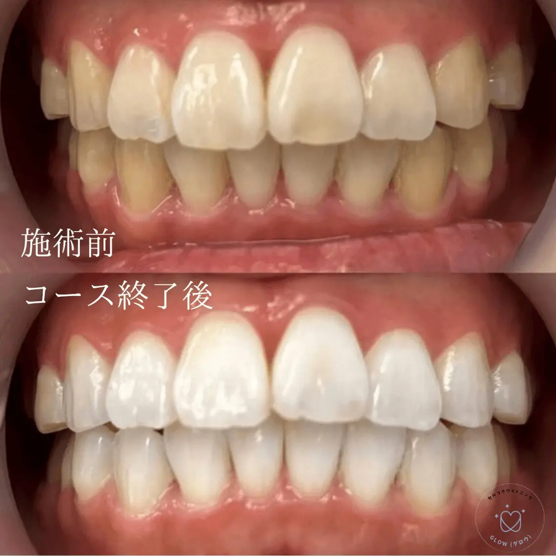 ※初回はジェルの注文のみです!【持続期間・白さにこだわるなら】歯科提携ジェルホワイトニング 美容ホワイトニングは当日可能の写真