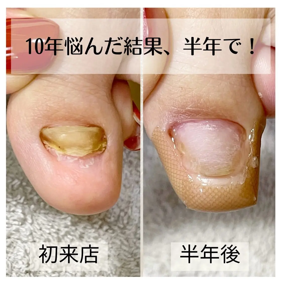 ネイル 巻き爪・肥厚爪ケア 専門サンセリテのネイルデザイン
