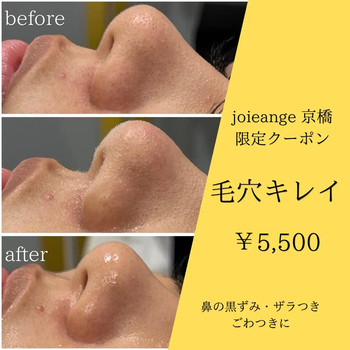 【ミニモ限定】鼻/顎/眉間の角栓,黒ずみ除去【溶ける角栓毛穴吸引&洗浄】¥5,980→¥4,980の写真