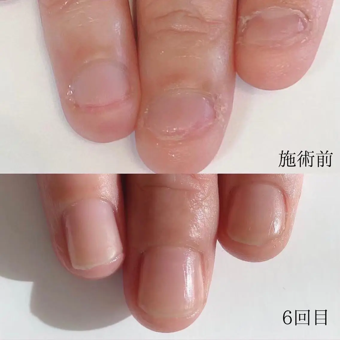 現在受付停止中。ケアだけで地爪育成❣️地爪を育てるネイルケア3ヶ月コース(ホームケア用品込) 1回約¥8,625円×8回の写真
